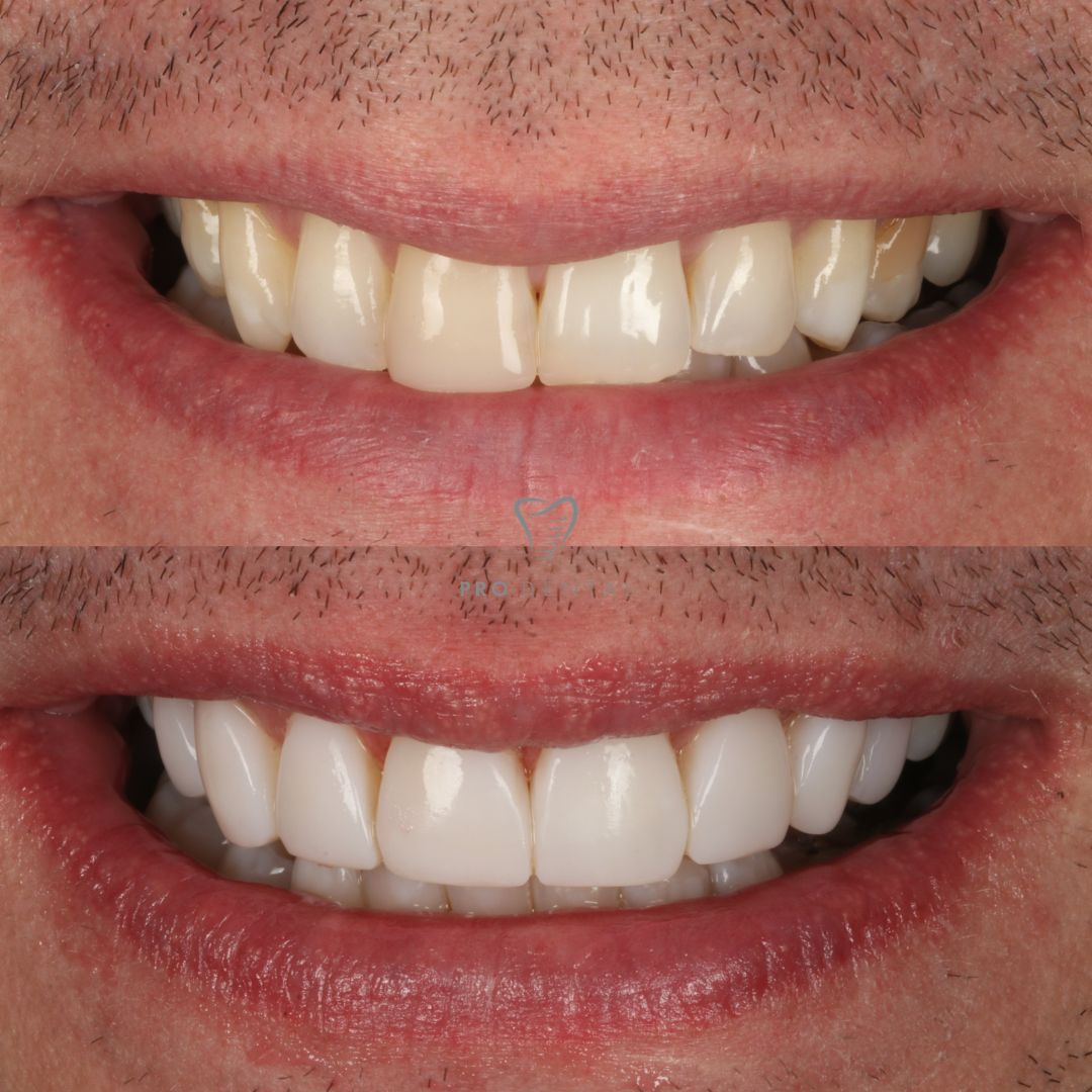 Before and after composite bonding on chipped and worn teeth