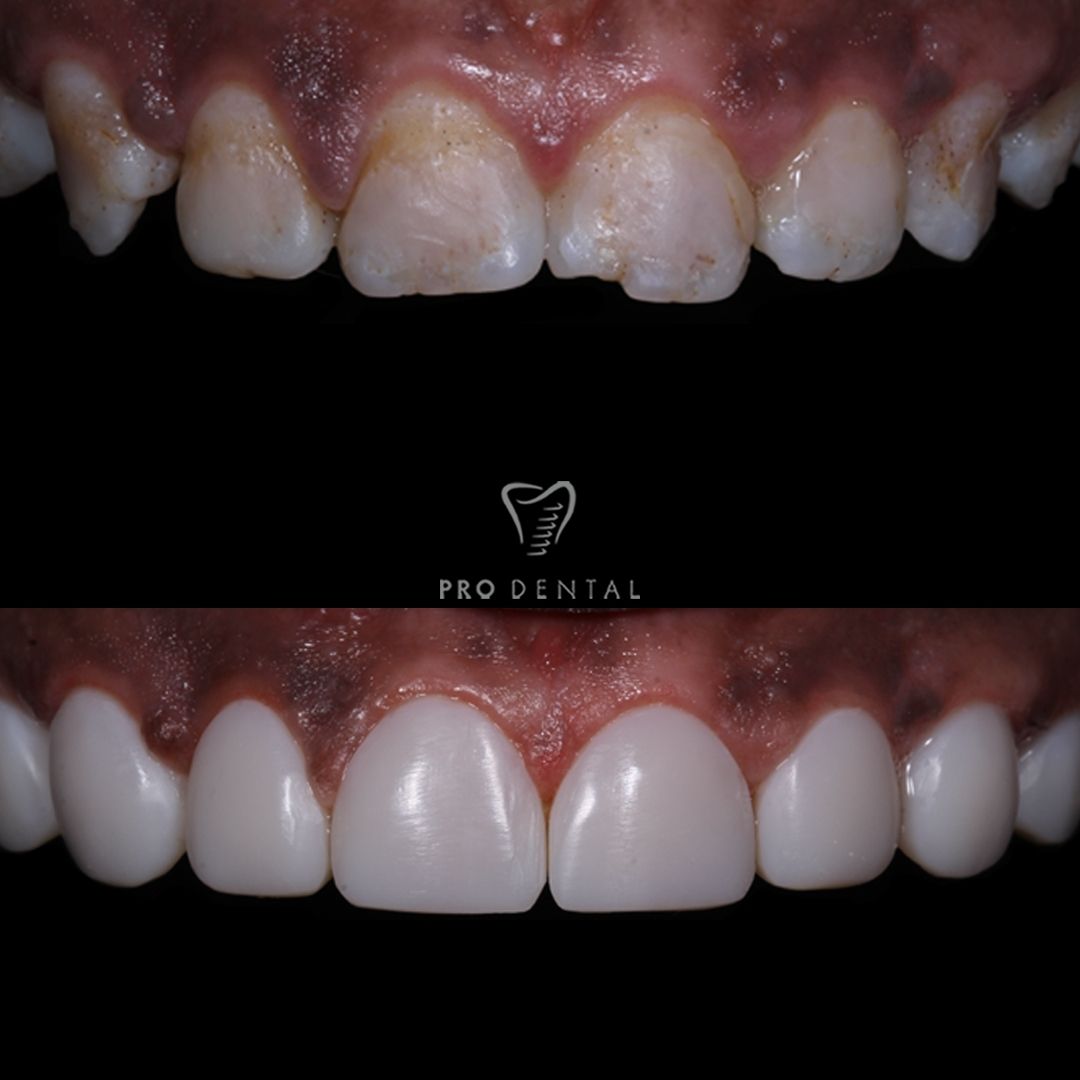 Before and after composite veneers on stained teeth