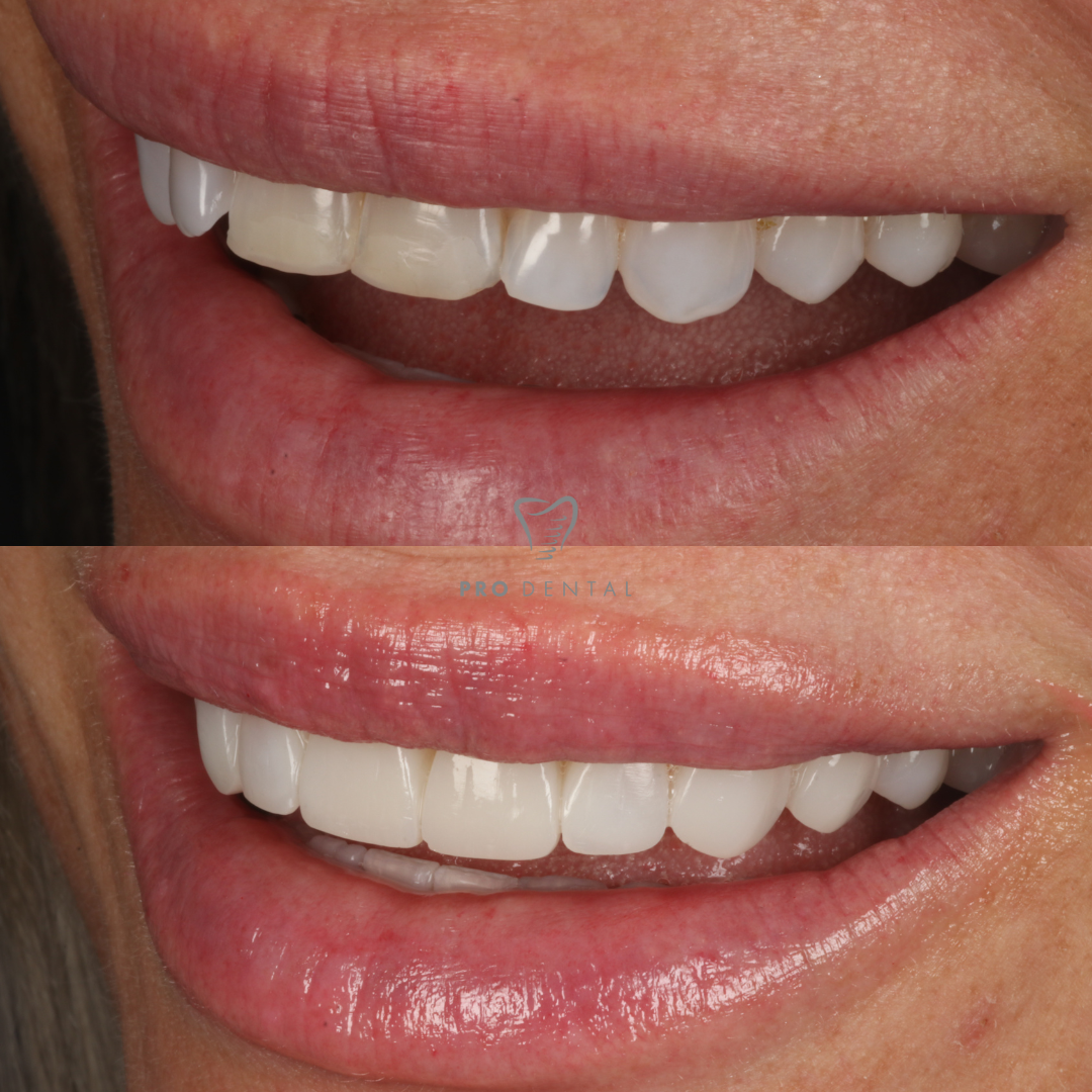 Before and after cosmetic smile transformation