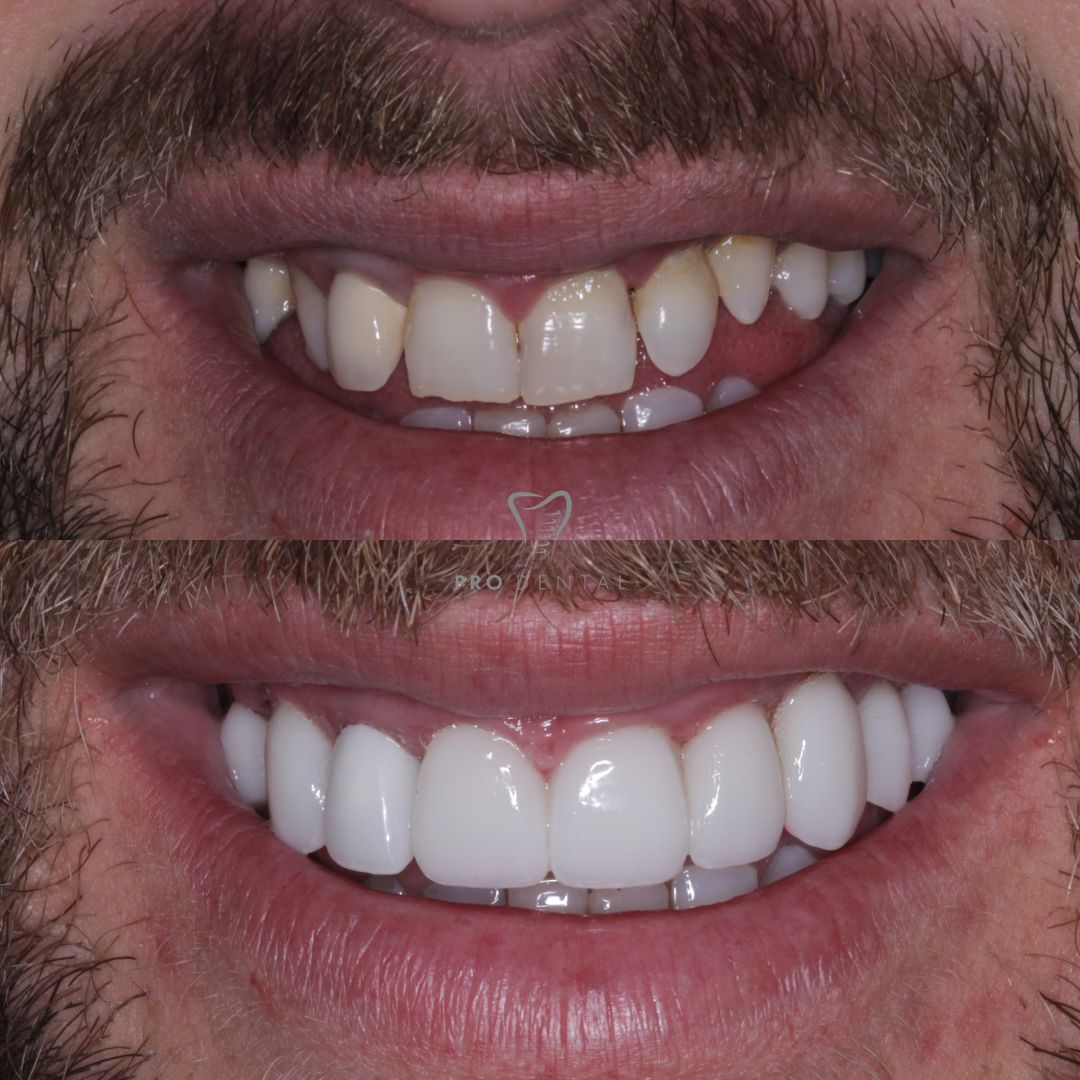 Before and after porcelain veneers on missing lateral incisor