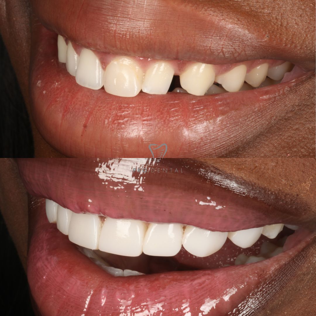 Before and after composite bonding closing gaps in smile